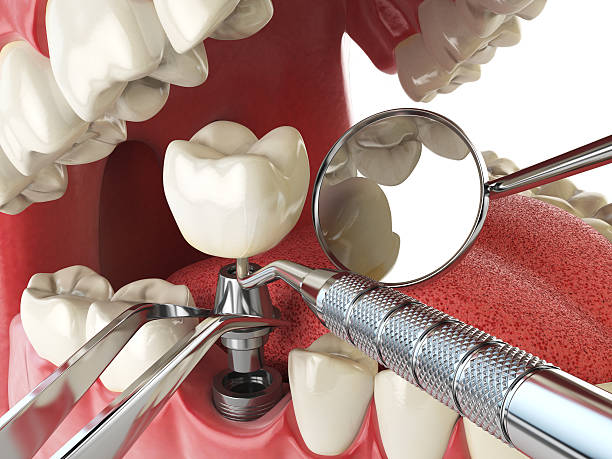 Best Emergency Root Canal Treatment in San Marcos, CA